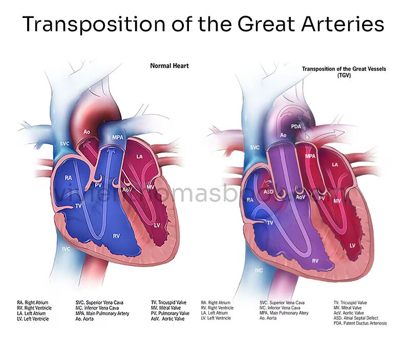 This diagram shows why the surgery Vivien Thomas devised for babies with Transposition of the Great Arteries was such a medically complex problem in 1947.